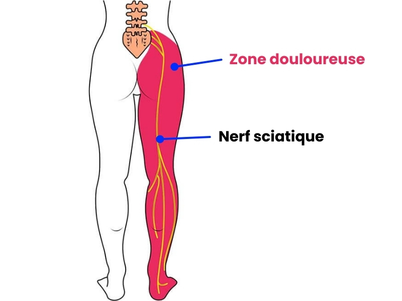 hernie-discale-sciatique.jpg