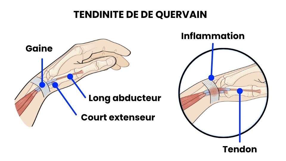 Schéma de la tendinite de De Quervain