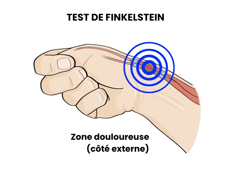 Test de Finkelstein pour détecter une tendinite de De Quervain