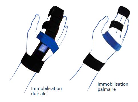 Immobilisation attelle digi immo thuasne