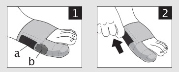 mise en place de l'orthèse corrective hallux valgus