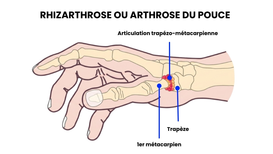 arthrose-pouce-exercices-rhizarthrose.jpg