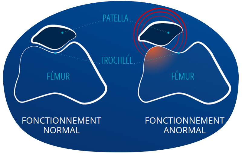 schéma syndrome rotulien